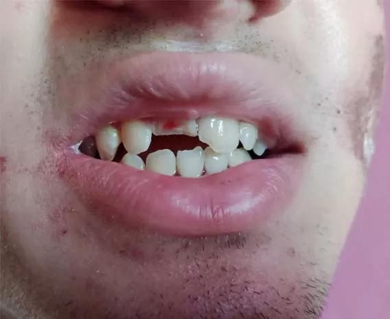 Boca