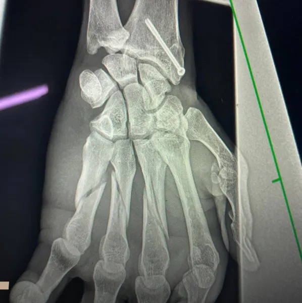 fractura