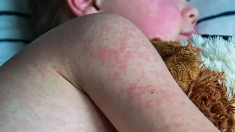 el-sarampion-es-una-enfermedad-viral-muy-contagiosa-que-puede-ser-grave-bebes-ninas-y-ninos-pequenos-y-puede-provocar-la-muerte