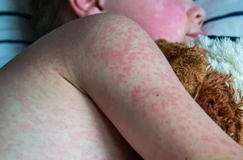 el-sarampion-es-una-enfermedad-viral-muy-contagiosa-que-puede-ser-grave-bebes-ninas-y-ninos-pequenos-y-puede-provocar-la-muerte
